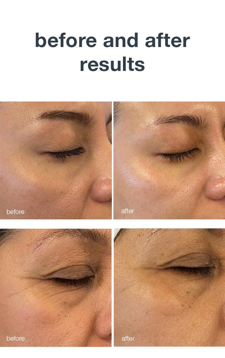 luminfusion pro dermalogica before and after results