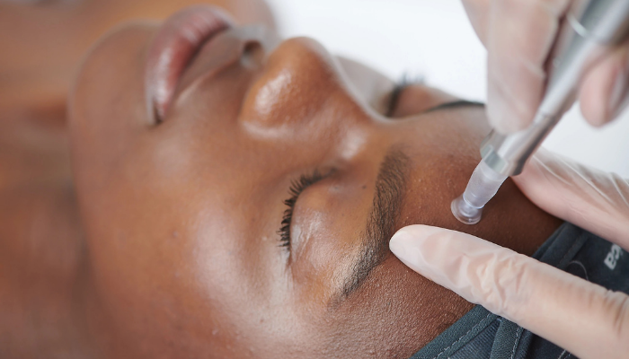 advanced skin treatments: what is microneedling and is it for my skin?