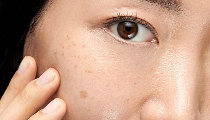hyperpigmentation: behind the brown spot