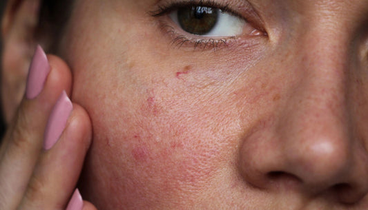 Rosacea Skincare Guide: Symptoms, Causes & Treatments