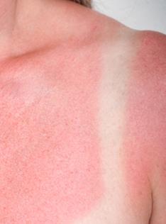 what is a sunburn?