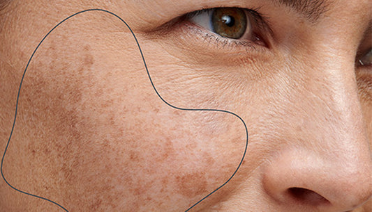 what causes uneven skin tone?
