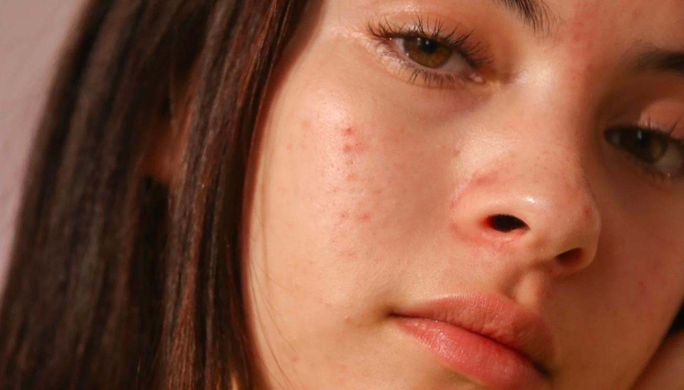 what's going on with my skin? puberty skin advice