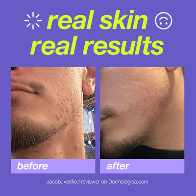 dermalogica cleansers breakout clearing foaming wash
