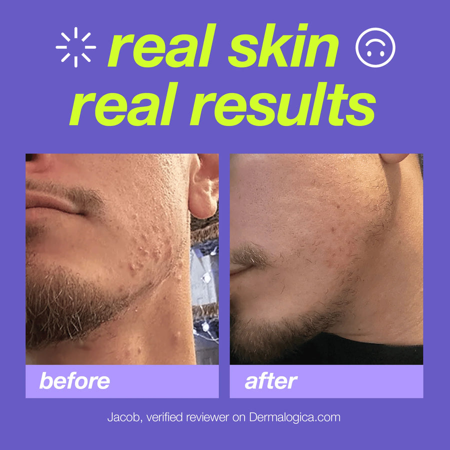 dermalogica cleansers breakout clearing foaming wash