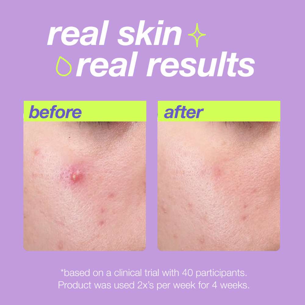 dermalogica exfoliants 30ml breakout clearing liquid peel