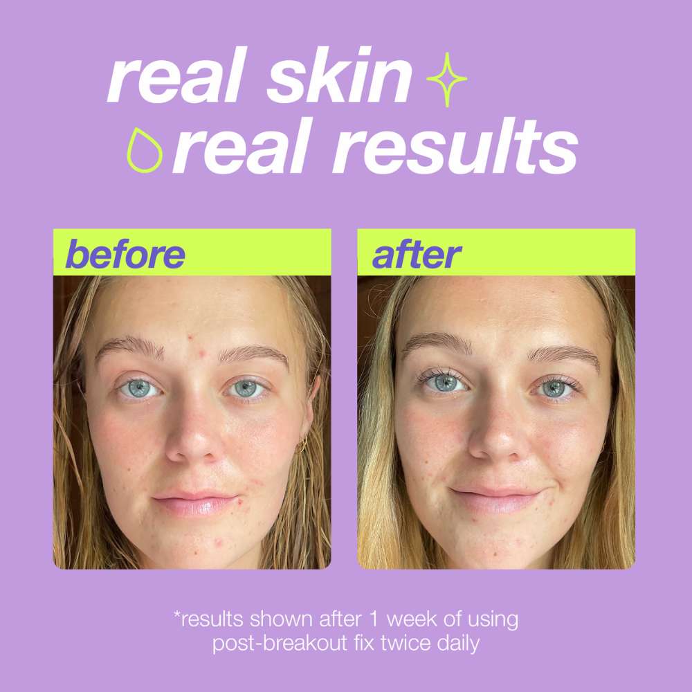 dermalogica targeted treatments 15ml post-breakout fix
