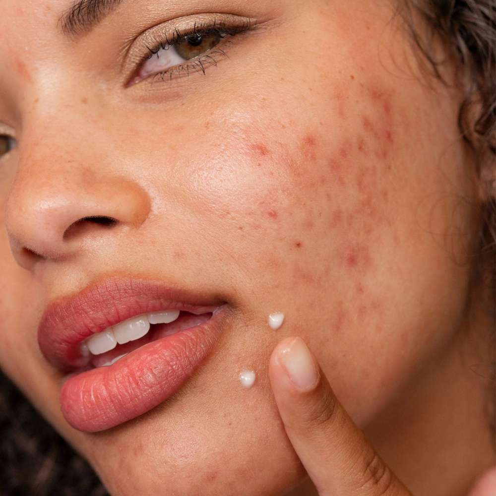 dermalogica targeted treatments 15ml post-breakout fix