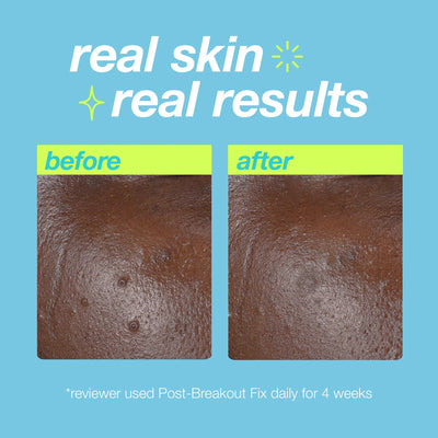 dermalogica targeted treatments 15ml post-breakout fix spot treatment